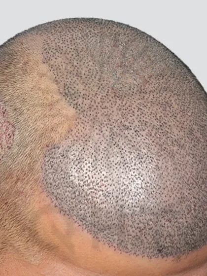 A look at the scalp just after surgery for a Grade 6 case. 5700 grafts were meticulously placed in a single session to recreate the hairline and add density from the frontal area to the crown.