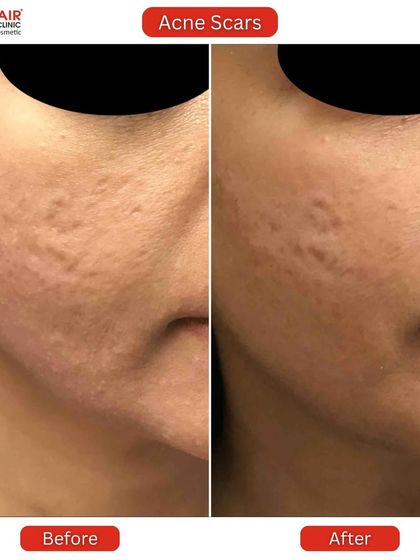 This before and after photo highlights the successful treatment of rolling acne scars on the cheek and jawline. The skin is visibly smoother and the shadows cast by the indentations are significantly diminished.