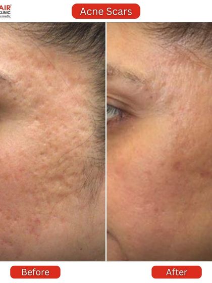 Here we addressed a combination of ice pick and boxcar scars. The "after" image shows a refined skin texture with shallower scars and a healthier overall appearance.