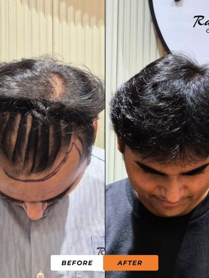 A top-down view of the patient in image 47. The 'before' shows the surgical markings for a large area of baldness, and the 'after' shows incredible coverage and density.