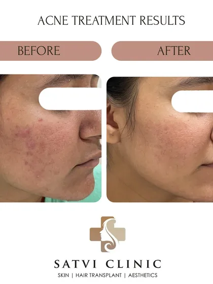 Every skin transformation requires patience and trust in the process. This patient's progress shows a remarkable reduction in redness and active acne, leading to clearer and healthier-looking skin over time.