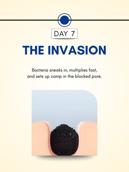 Day 7: Bacteria that naturally live on the skin find their way into the clogged pore. Here, they multiply quickly, creating an environment for inflammation.