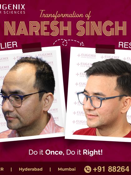 The complete transformation of Naresh Singh, showcasing a restored hairline and renewed look.