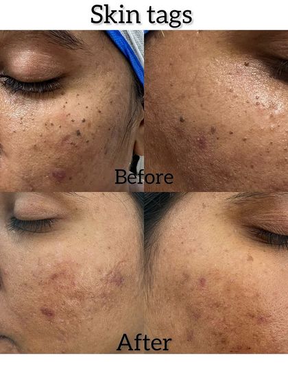 Skin tags and similar growths on the face and neck are a common concern. This before and after demonstrates how we can permanently remove these pesky spots in a single, affordable session for clear, smooth skin.