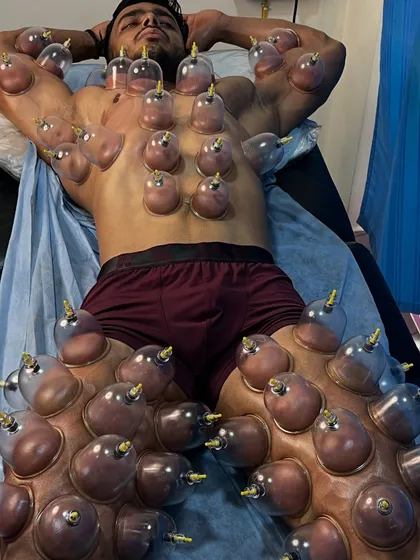A full-body dry cupping session. Applying cups to the chest, arms, and legs is beneficial for athletes who need comprehensive muscle recovery.
