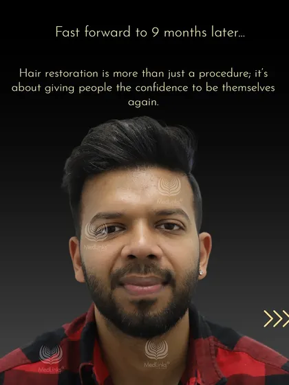 Nine months later, Aman's transformation is complete. Hair restoration is about giving people the confidence to be themselves again.