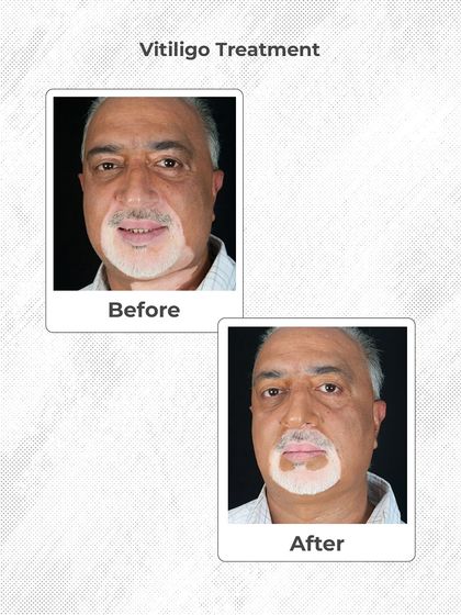Vitiligo requires a specialized and patient approach. This before and after shows the progress of a vitiligo treatment, helping to restore pigment and confidence.
