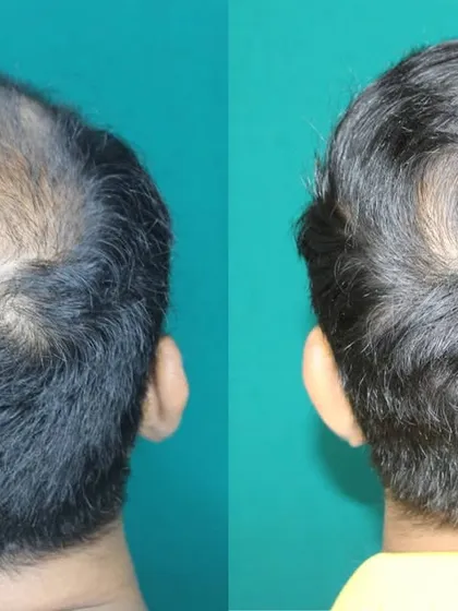 The crown area, or vertex, is a common area of concern. Here, you can see how I successfully filled in a significant bald patch on the crown. My technique ensures the hair grows in the correct direction, mimicking the natural whorl pattern for an undetectable result.