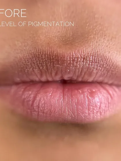 This image shows the before state of pigmented lips, a common concern for many. With treatments like fillers and lip neutralization, I can help restore a healthy, even tone and shape.