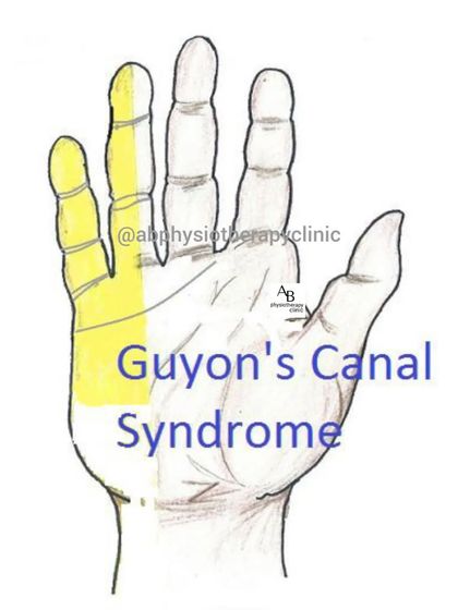 Guyon's Canal Syndrome, or "handlebar palsy," involves compression of the ulnar nerve at the wrist. It's common in cyclists and causes numbness in the ring and pinky fingers.