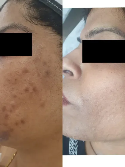 This before and after image shows a significant reduction in pigmentation and acne marks. We achieved this transformation through a personalized treatment plan involving multiple sessions. It demonstrates how a consistent, medically supervised approach can effectively address deep-seated pigmentation and restore an even, clear complexion.