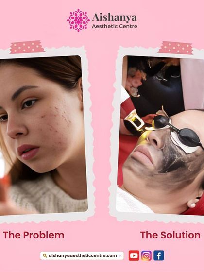 This graphic shows the problem of acne and dull skin, and the solution: a Carbon Laser Peel. It's a great visual to understand how this treatment can transform your complexion.