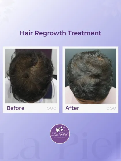 Here you can see the results of a targeted hair regrowth treatment for male pattern thinning. We successfully increased hair volume and scalp coverage, leading to a fuller and healthier appearance.