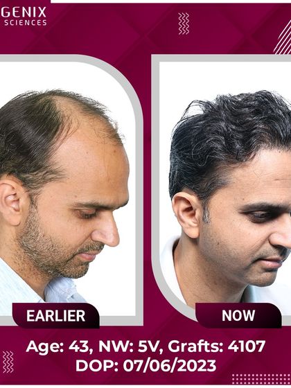 See the transformation of a 43-year-old with Grade 5V baldness, restored with 4107 grafts for a natural, lasting result.
