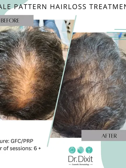 Male pattern hair loss is progressive, but with the right intervention, we can achieve great results. This patient underwent a series of GFC and PRP treatments, which strengthened existing follicles and improved hair thickness across the crown area.