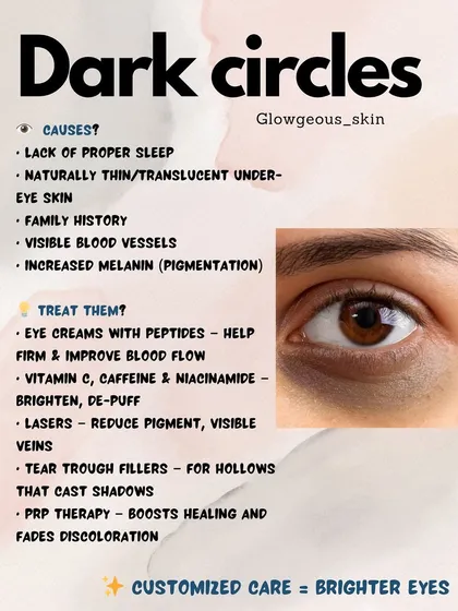 Dark circles are not just about lack of sleep. They can be caused by genetics, thin skin showing blood vessels, or volume loss creating shadows. I use a combination of treatments like brightening eye creams, lasers to reduce pigment, and tear trough fillers to correct hollowness for truly brighter eyes.