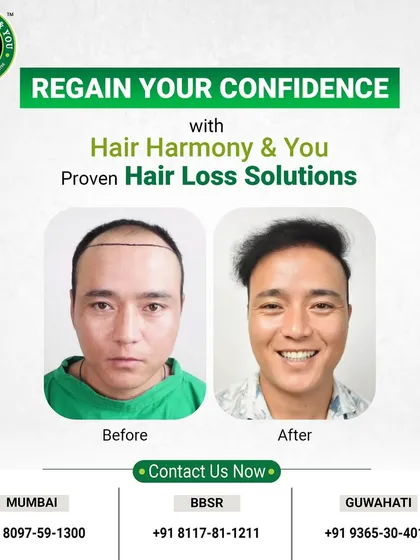 A picture is worth a thousand words, and this before and after comparison says it all. Notice the natural-looking hairline and the incredible boost in confidence, evident in his smile. This is the kind of life-changing result I strive for with every client.