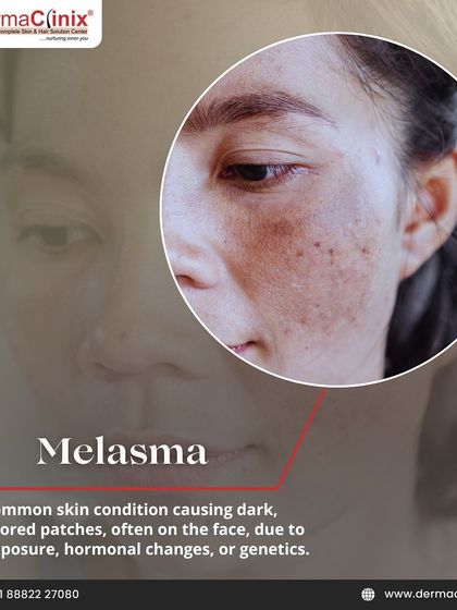 This image shows Melasma, a common skin condition causing dark, discolored patches, often due to sun exposure or hormonal changes. We offer specialized treatments for this concern.