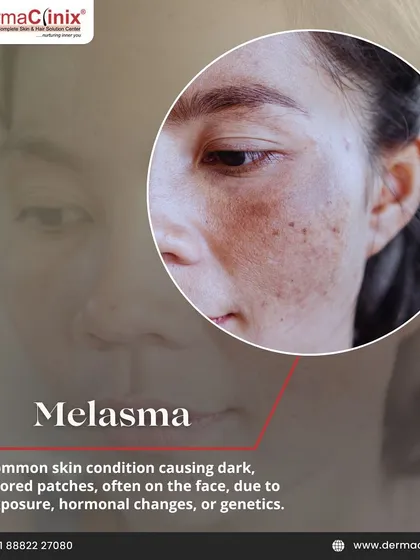 This image shows Melasma, a common skin condition causing dark, discolored patches, often due to sun exposure or hormonal changes. We offer specialized treatments for this concern.