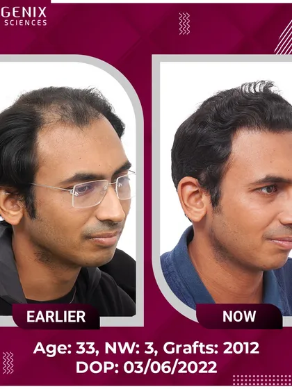 A 33-year-old's successful restoration from Grade 3 baldness with 2012 grafts.