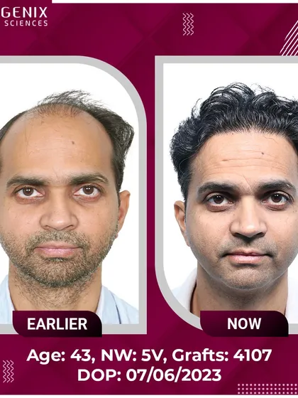 See the transformation of a 43-year-old with Grade 5V baldness, restored with 4107 grafts for a natural, lasting result.