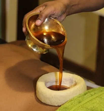 This is Kati Basti, one of the most effective treatments I provide for chronic lower back pain. We create a reservoir from dough on the lumbar region and fill it with warm, medicated oil. This process deeply nourishes the tissues, relieves muscle spasms, and provides significant relief for conditions like sciatica and spondylosis.