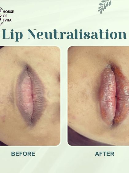 This image clearly shows the power of Lip Neutralization. The darker pigmentation on the upper and lower lips has been balanced for a consistent, natural color.