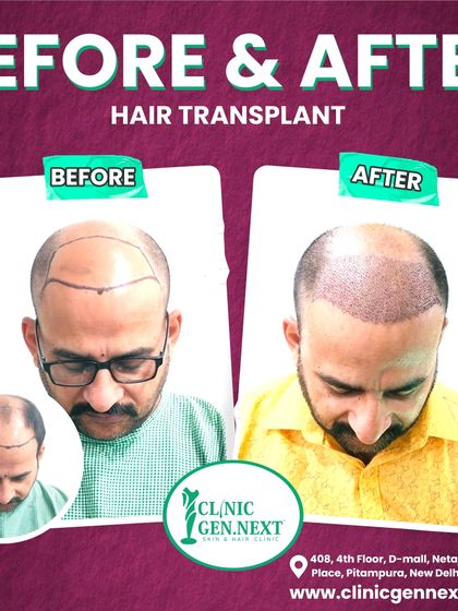 This before-and-after image shows the patient before the procedure with the hairline marked, and immediately after, with the grafts densely packed for a great future result.