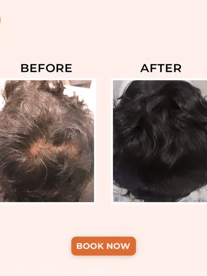 This is the kind of transformation that is possible with a consistent, personalized hair restoration plan. This patient's results show a significant increase in hair density and scalp coverage, restoring not just their hair, but their confidence.