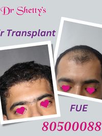 Hair Restoration & Removal