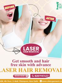 Laser Hair Removal