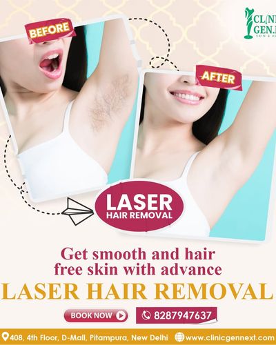 Laser Hair Removal