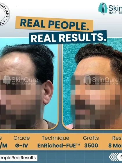 A side view of the 35-year-old patient's 8-month result. This angle demonstrates the natural hairline design and the seamless transition from the transplanted area to the existing hair.