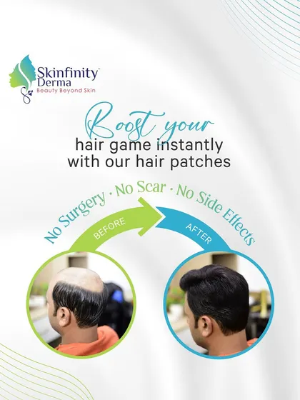 Looking for an instant, non-surgical solution for baldness? Our hair patches are custom-made to blend seamlessly with your natural hair, providing immediate volume and coverage with no surgery, scars, or side effects.