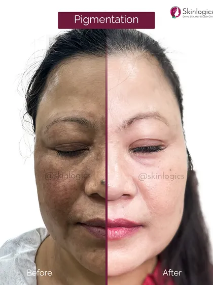 A split-view of the patient from images 33 and 34, offering a stark contrast between the pigmented skin and the successfully treated, clearer skin.