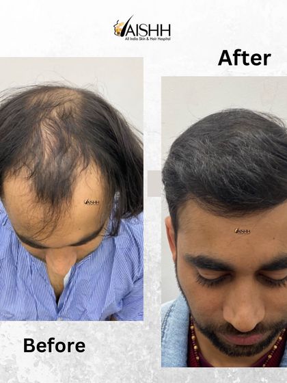 A clear before-and-after view of the patient from the previous video. This image shows the impressive coverage we achieved for his Grade 4-5 baldness after 10 months.