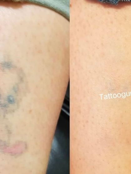 This was an older, faded tattoo with traces of black, blue, and red ink. The after photo shows the skin is much clearer and the tattoo is almost entirely gone.