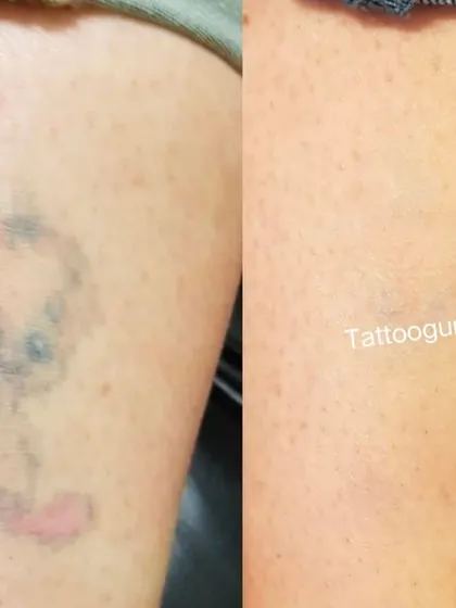 This was an older, faded tattoo with traces of black, blue, and red ink. The after photo shows the skin is much clearer and the tattoo is almost entirely gone.