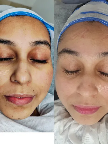 A powerful transformation using the Millifrac treatment. The client's skin in the 'after' photo is visibly smoother, with a reduction in textural irregularities and a healthier overall appearance.