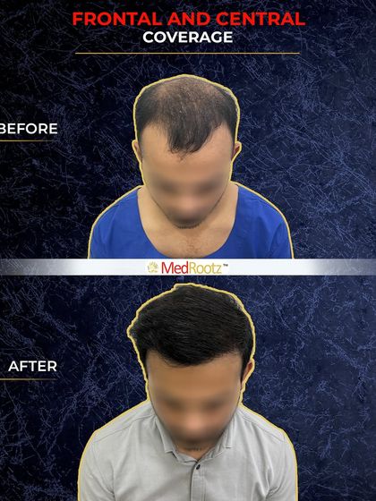 Here you can see a top-down view of Naseem's transformation. We focused on achieving dense frontal and central coverage, which is critical for a natural-looking result.