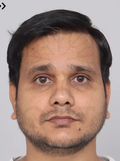 This Norwood Grade 4A patient's 14-month transformation after a single session with 4000 grafts. We restored his hairline and frontal region for a fuller, more confident look.