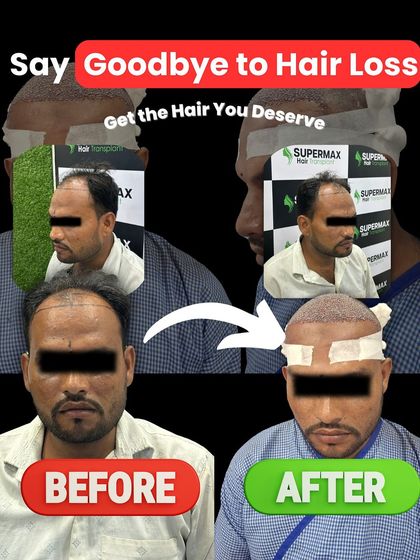 Say goodbye to hair loss. This before and after collage shows how we can give you the hair you deserve.
