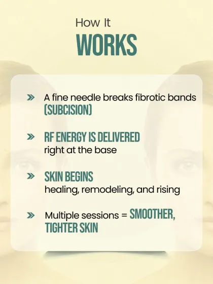 This graphic explains how our Subcision with RF treatment works. A fine needle is used to break the fibrotic bands tethering the scar, while RF energy is delivered at the base to stimulate collagen and help the skin remodel and rise.