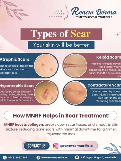 Understanding the type of scar you have, whether atrophic, keloid, or hypertrophic, is the first step. This graphic explains how MNRF works to treat different scars by boosting collagen and breaking down scar tissue.
