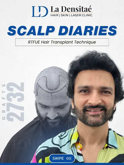 This "Scalp Diaries" post for Mr. Rajesh Kava highlights the 2,732 grafts that restored his look. The change isn't loud; it's about him feeling like himself again, and that's what matters most.