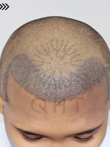 Fresh graft placement for a Grade 2 case. We used 2400 grafts to recreate the hairline, enhance the frontal region, and design natural temples.