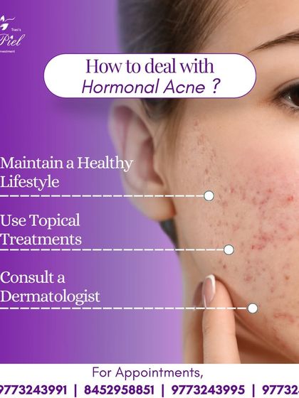 Hormonal acne requires a specific approach. This guide outlines key strategies for managing it, including maintaining a healthy lifestyle, using the right topical treatments, and the importance of consulting a dermatologist to create a personalized and effective plan.