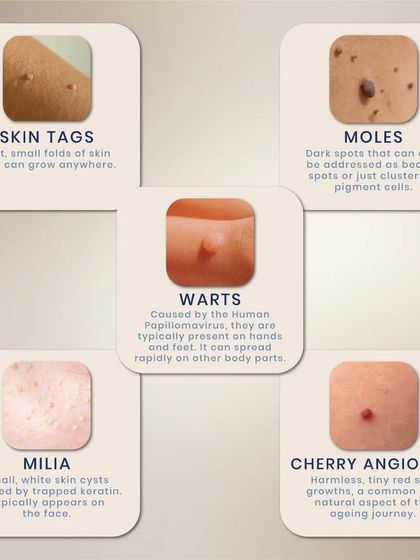 Let's decode common skin growths. This guide explains the differences between skin tags, moles, warts, milia, and cherry angiomas, helping you understand what's on your skin.