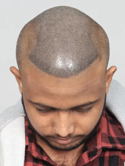 This is what a scalp looks like immediately after the procedure. Each dot is a carefully placed graft, the foundation of a future full head of hair.