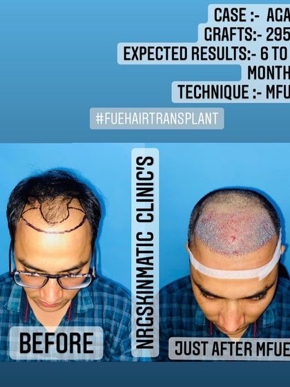 This image shows a client before the procedure and immediately after the placement of 2956 grafts using the MFUE technique. You can see the clean, dense placement which is the foundation for great results in 6 to 8 months.